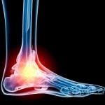 Treating Foot and Ankle Arthritis