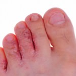Athletes Foot Versus Dry Skin from a Georgia Podiatrist