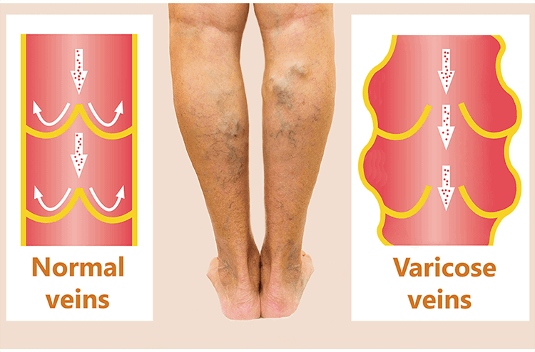 spider and varicose veins