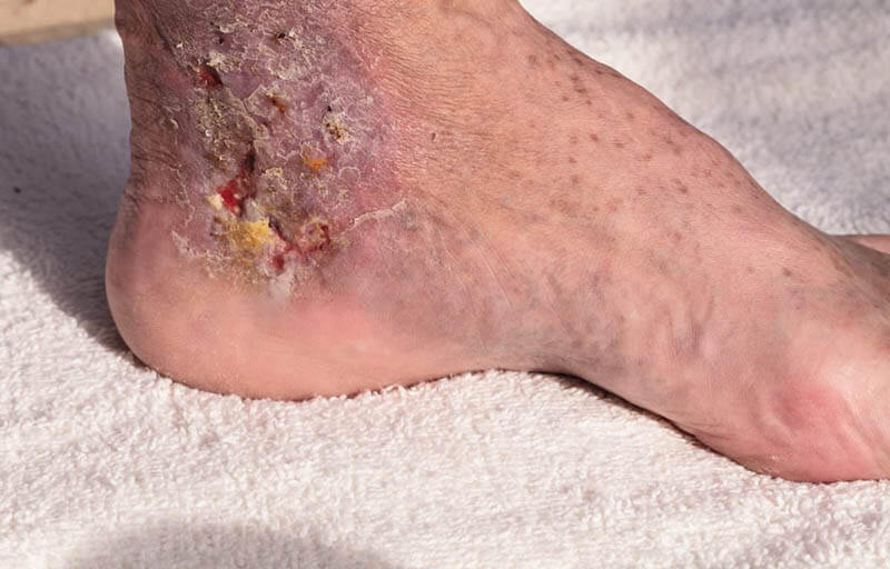 Diabetic Foot Ulcer Podiatry Group of Georgia