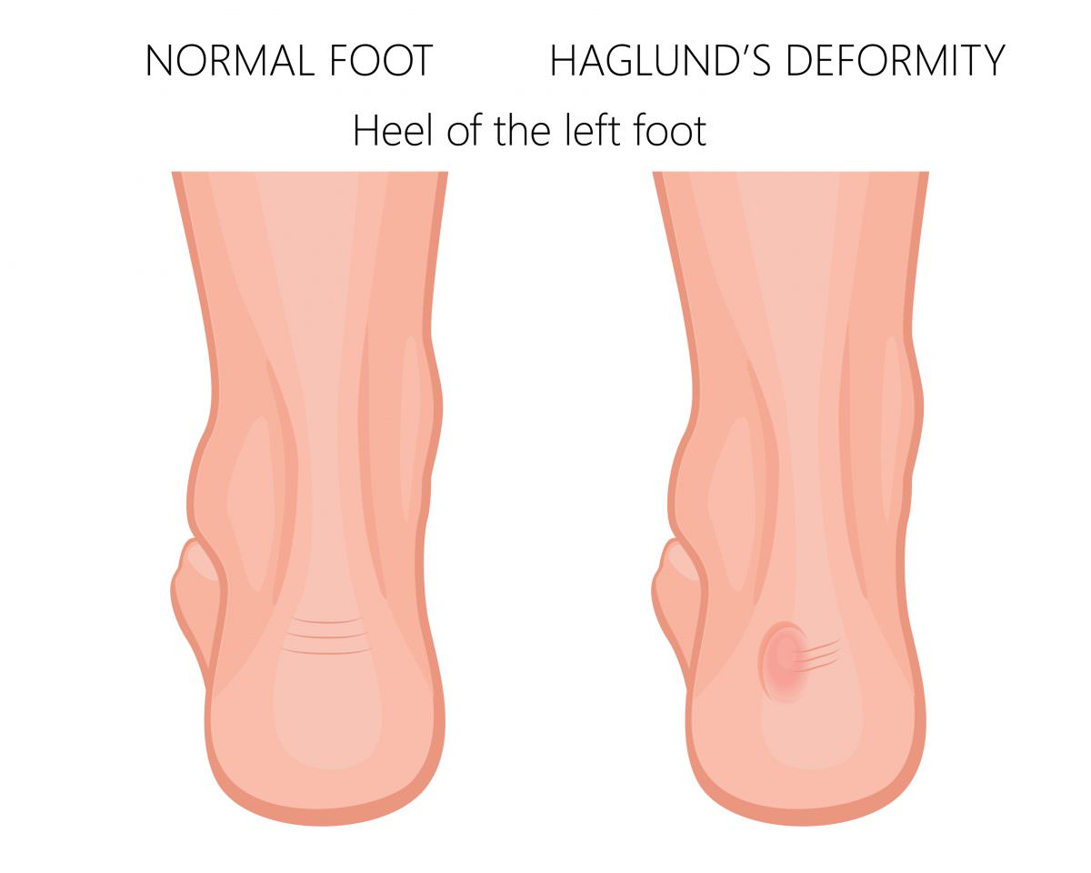 Haglund's Deformity Podiatry Group of Georgia