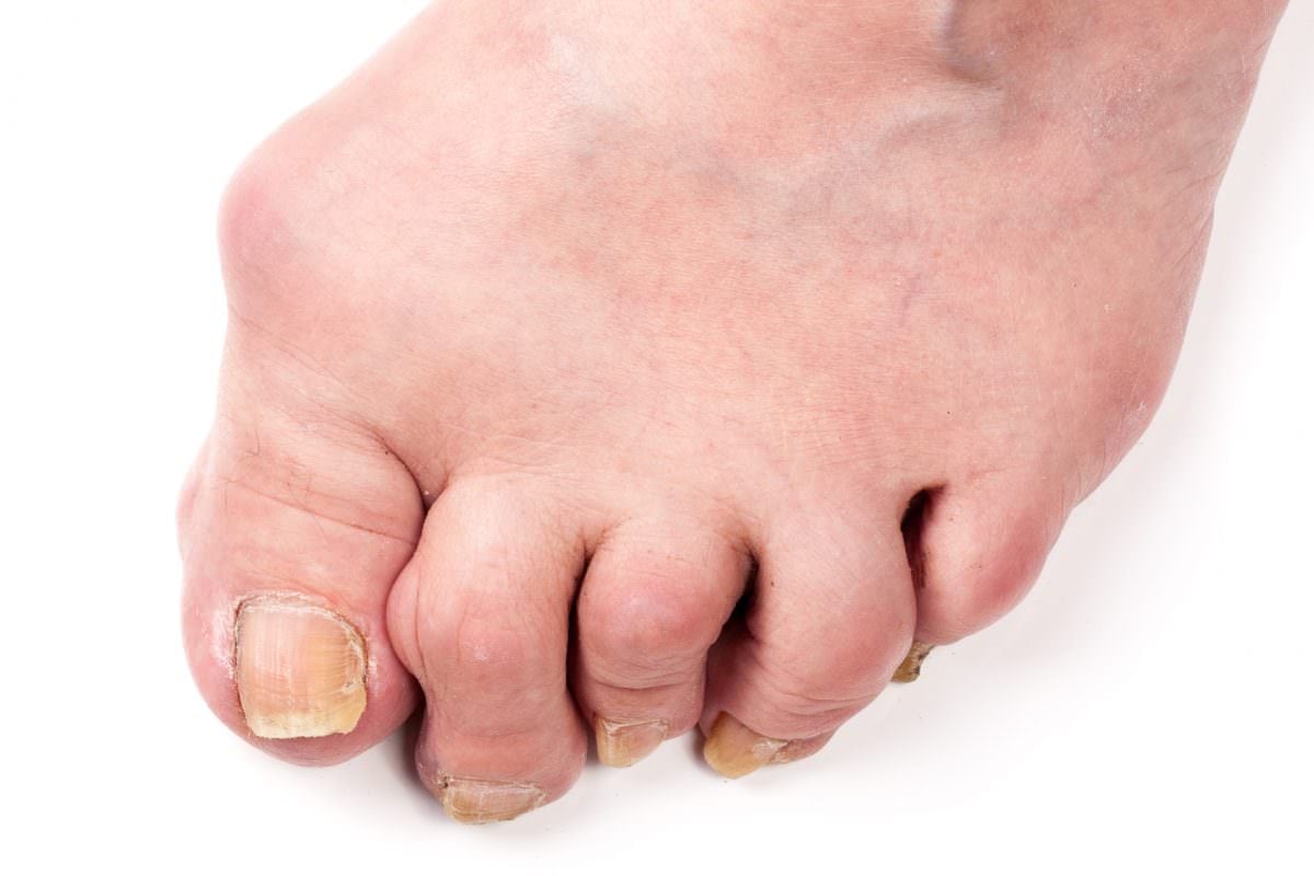 Rheumatoid Arthritis in The Foot Podiatry Group of Georgia