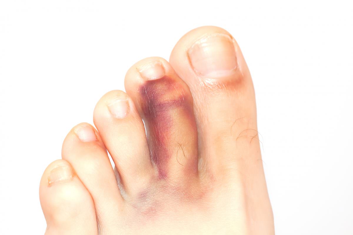 Toe Fracture Podiatry Group of Georgia