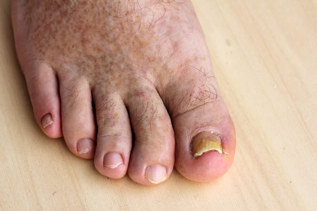 Toe Infection Podiatry Group of Georgia