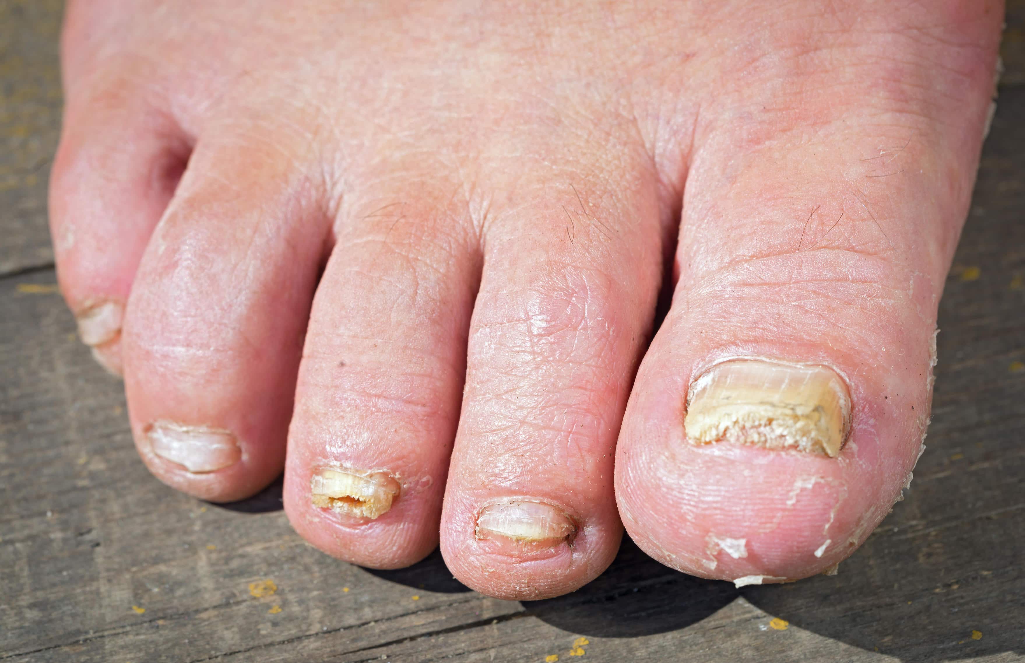 Ugly nails may be cause by toenail fungus, or onychomycosis, is an infectio...