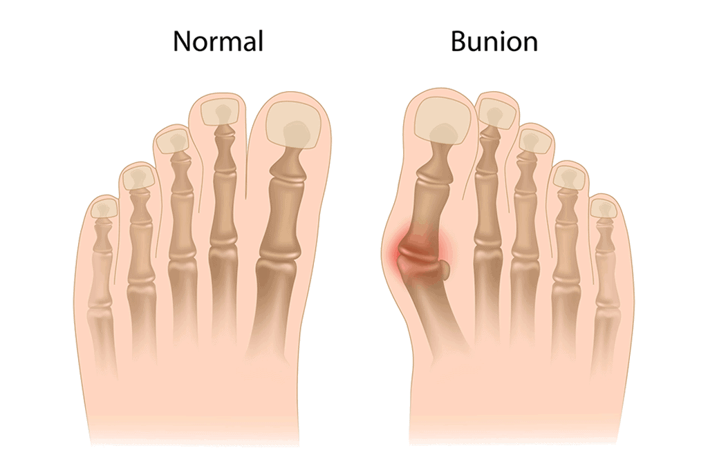 What are Bunions and How Do They Develop?
