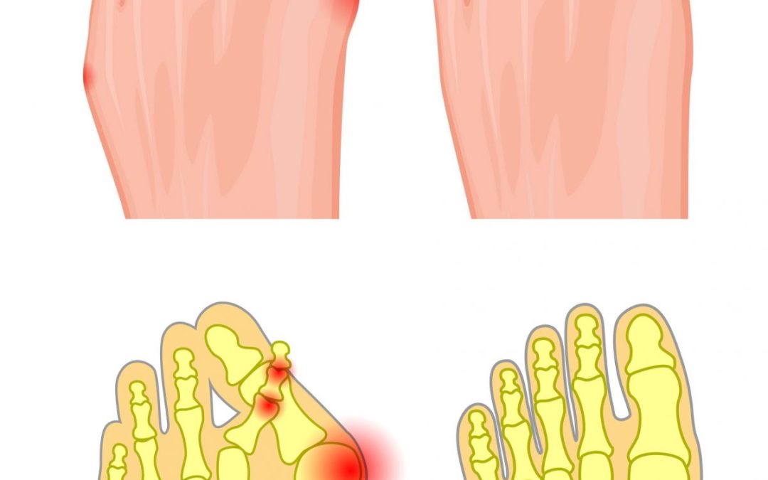 Hammer Toe Correction via Arthroplasty