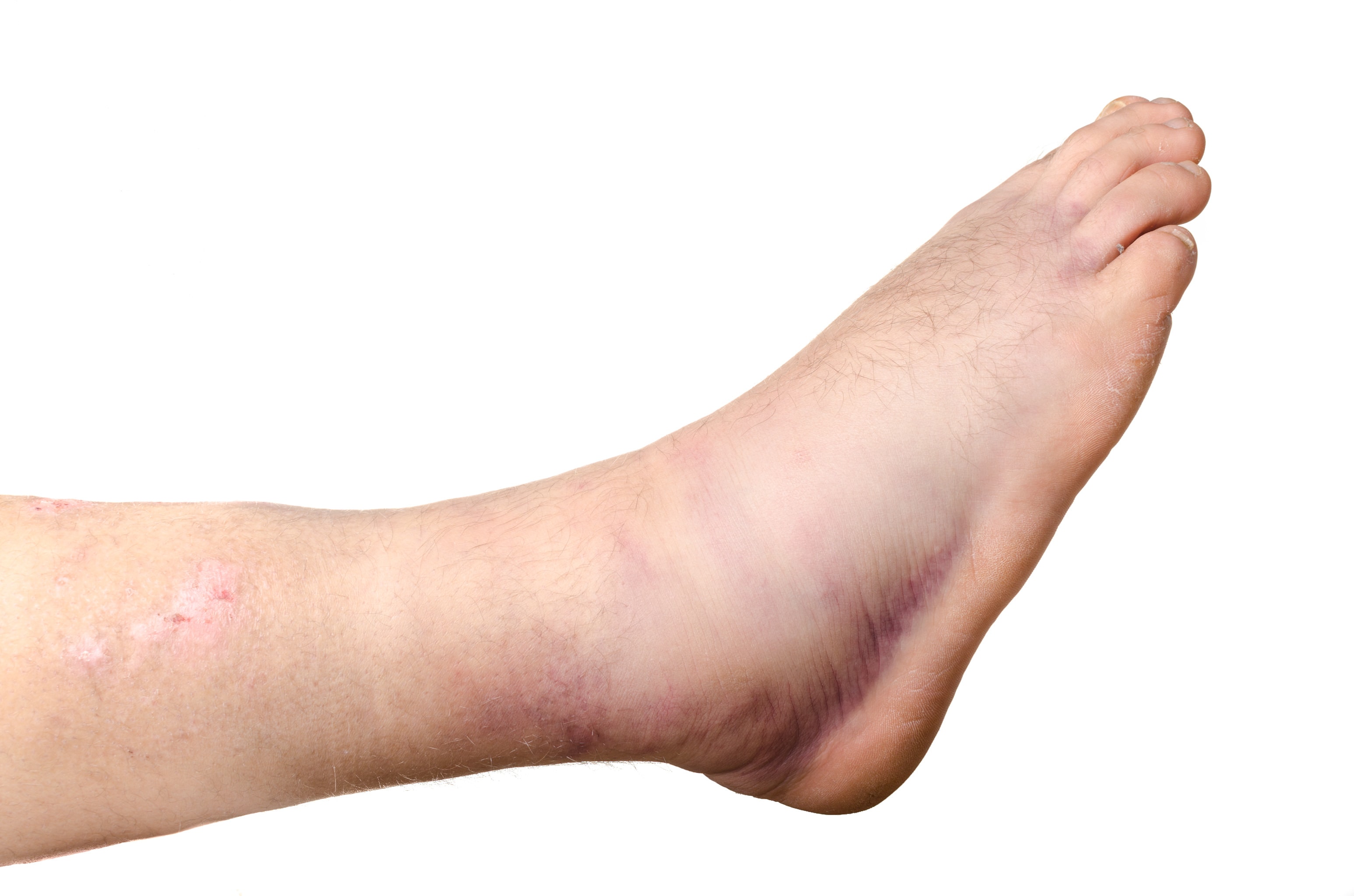 Broken Ankle | Foot Doctor | Marietta And Atlanta Area| Read More!