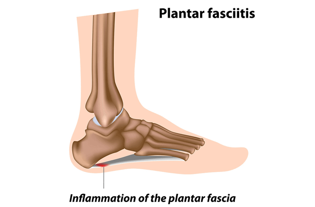 Plantar Fasciitis Symptoms And Causes