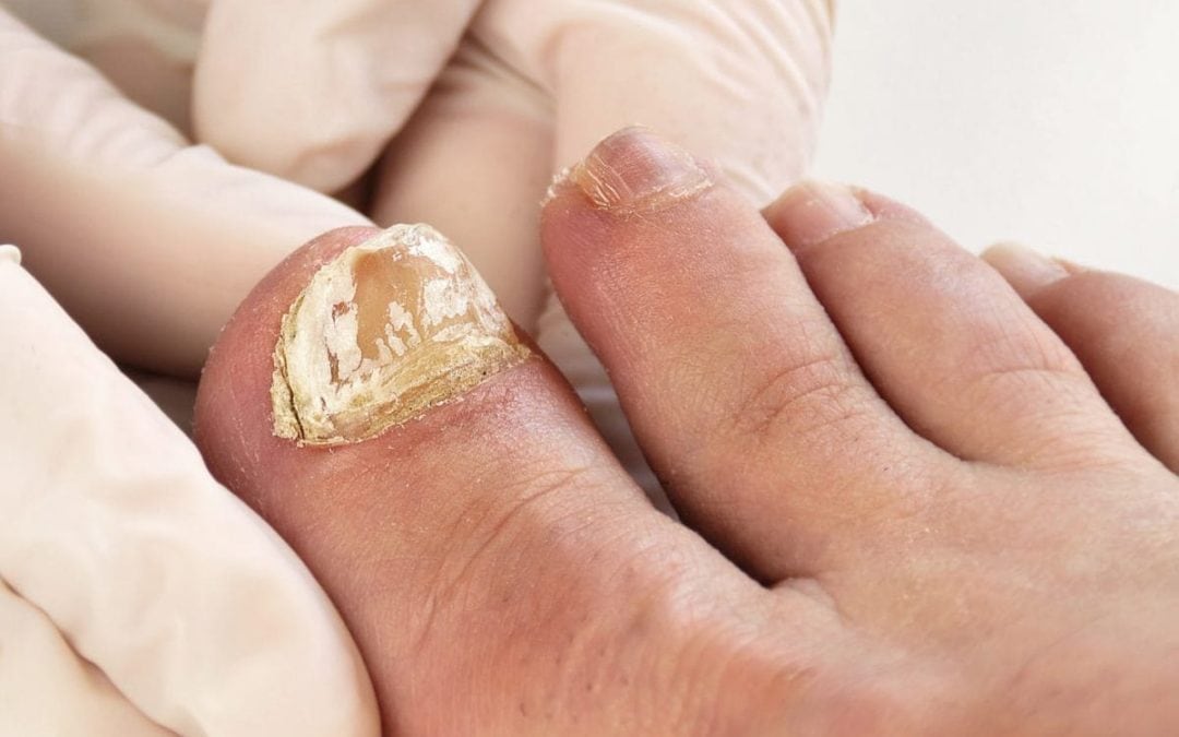 Learn How Our Podiatrist Uses a Laser To Remove Toenail Fungus
