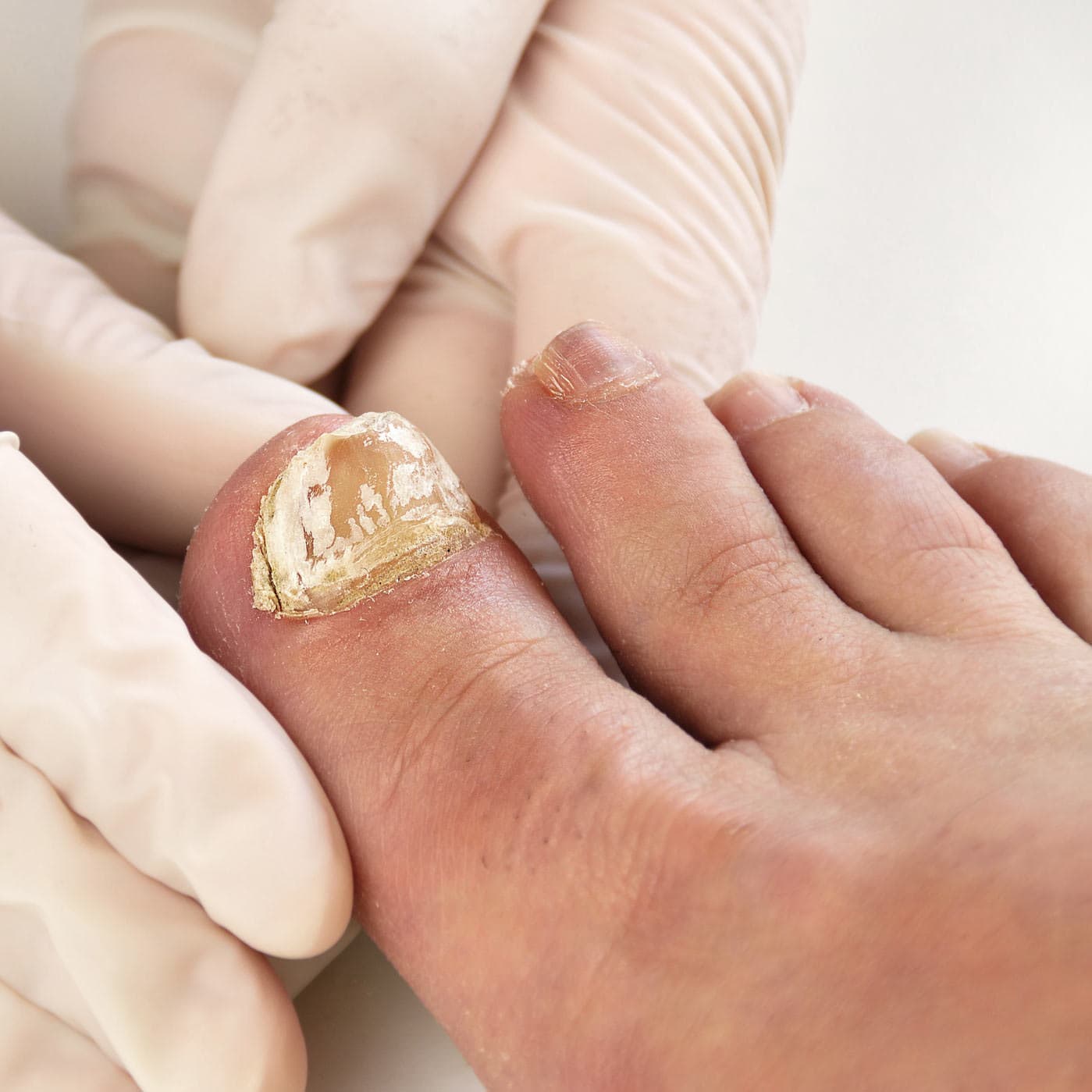 Can Toenail Fungus Spread Through Nail Polish Foot Doctor Marietta.