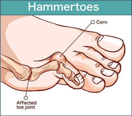 Hammer Toe Surgery