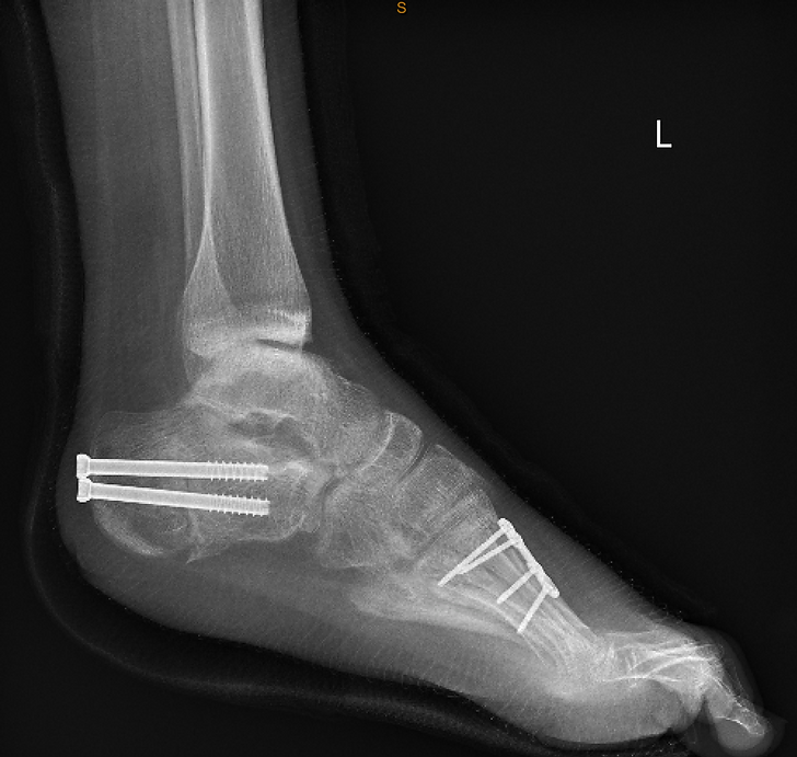 Fixation for Surgery, Why Screws