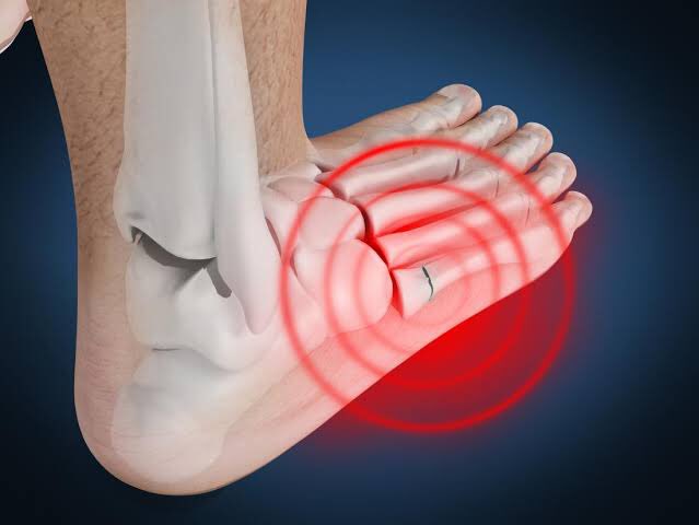 Avulsion Fracture