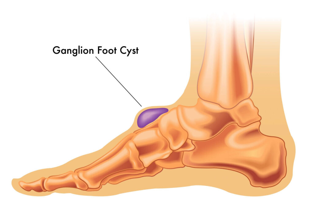 Ganglion Treatment via Surgical Excision