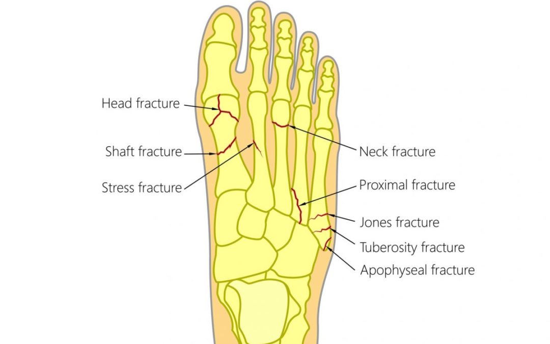 Metatarsal-surgery
