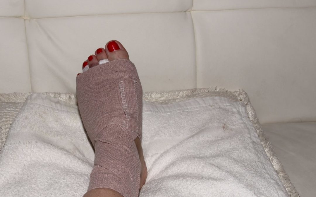 Neuroma Surgery