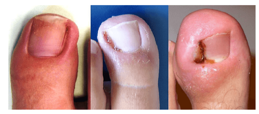 avulsion