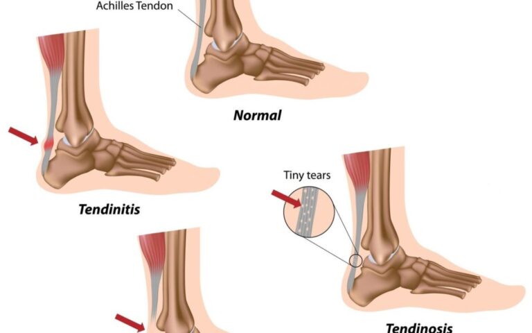 achilles tendon