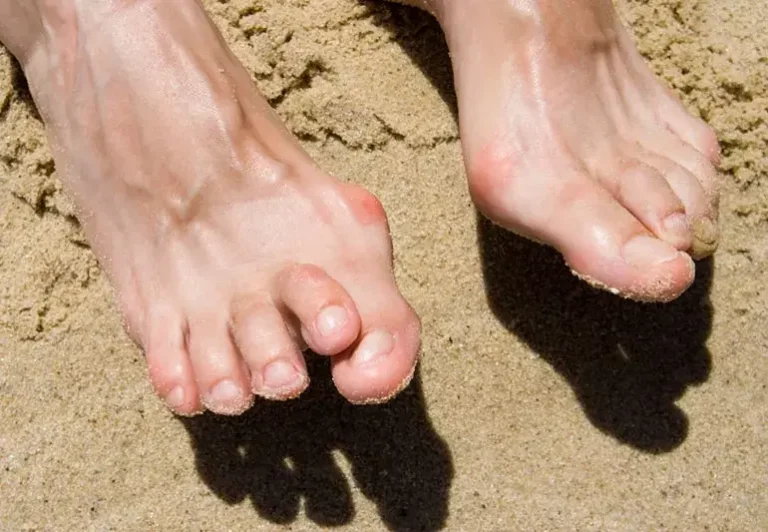 Hammertoes