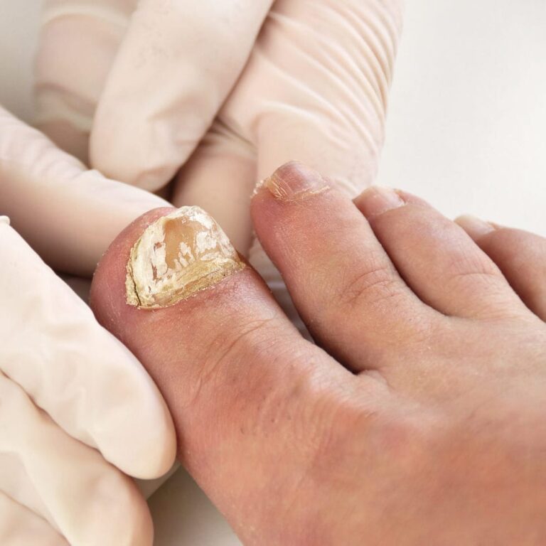 Toenail Fungus